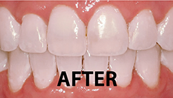 Teeth After Professional Whitening :-D